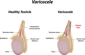 Varicocele: Common Cause of Male Infertility & its Treatment - SCI  International Hospital
