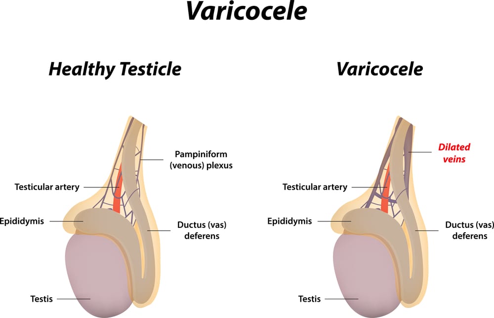 Varicocele Natural Treatment Or Varicocele Surgery?