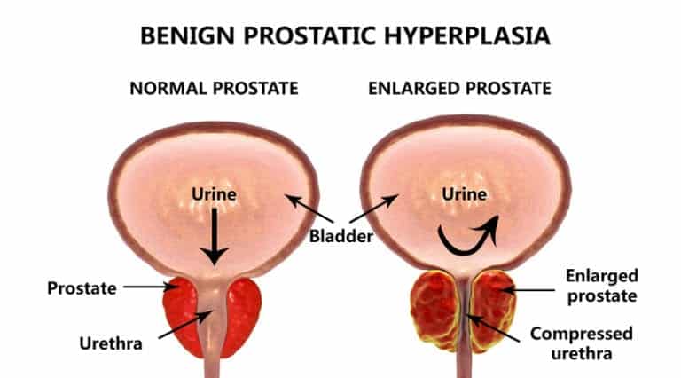 Enlarged Prostate | BPH in Chattanooga TN - Anand Shridharani, MD ...